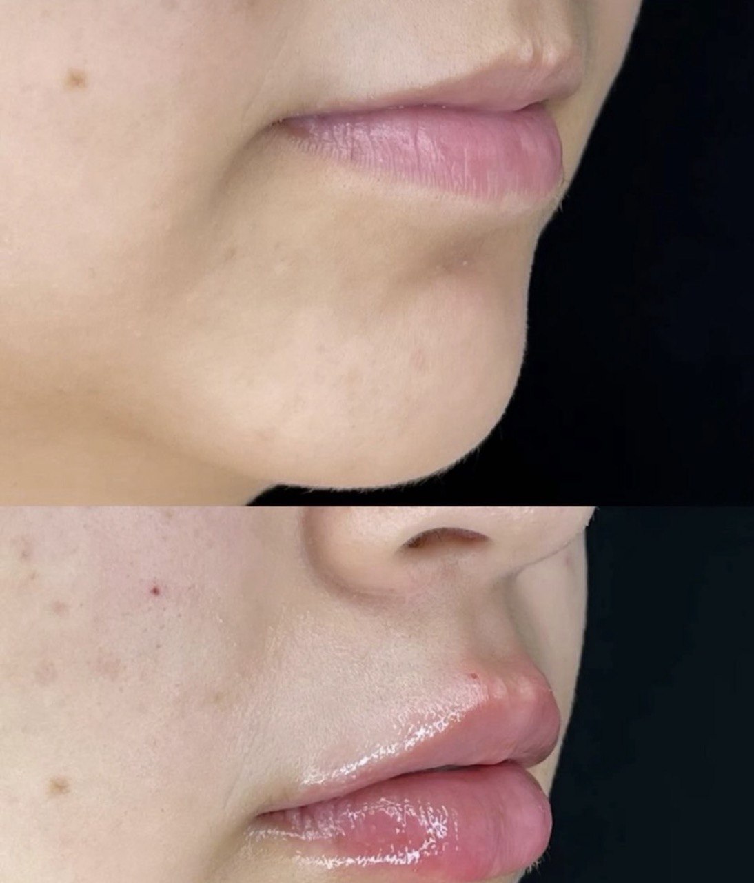 Before and after lip enhancement result